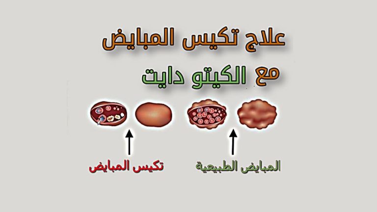 علاج تكيس المبايض باستخدام نظام كيتو دايت الغذائي